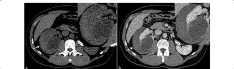 Ct Showing A Large Hematoma Arrow Surrounded By Gerotas Fascia In