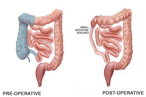 Hemicolectomy Procedure To Remove One Side Of The Colon Right Hemicolectomy