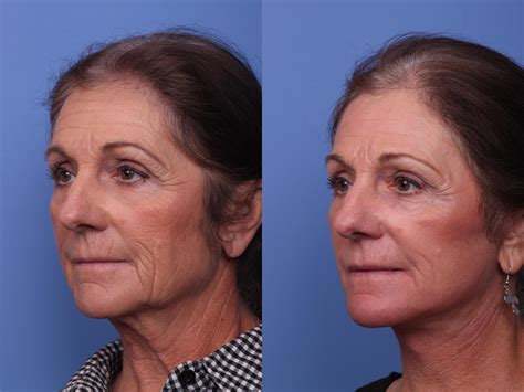 Facelift Before And After Pictures Case 318 Scottsdale Az Hobgood Facial Plastic Surgery
