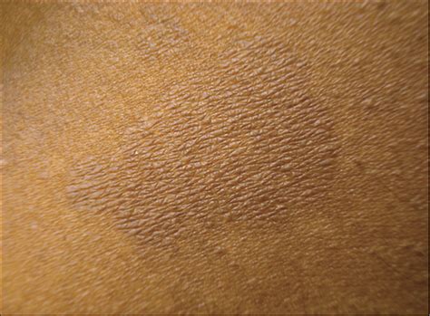 Evoked Scale Sign Of Tinea Versicolor Dermatology Jam