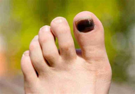 How To Prevent And Treat Black Toenail From Running 2024