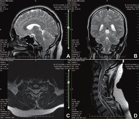 Chiari Malformation Type I A B Sagittal And Coronal T Weighted