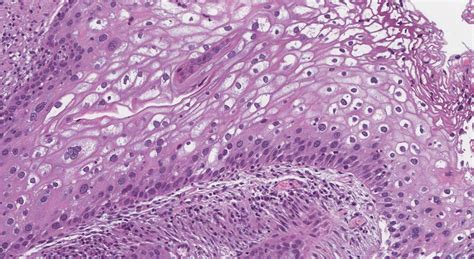Low Grade Squamous Intraepithelial Lesion Of The Cervix Atlas Of