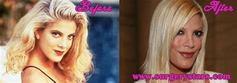 Tori Spelling Plastic Surgery Before After Photo