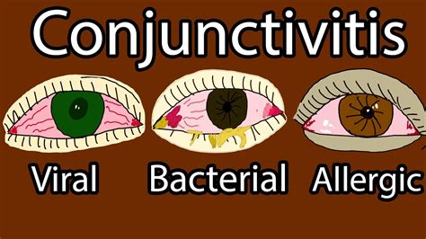 Pink Eye Conjunctivitis Viral Bacterial And Allergic