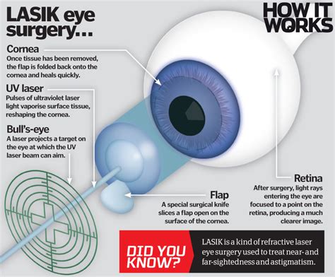 How Does Laser Eye Surgery Work How It Works