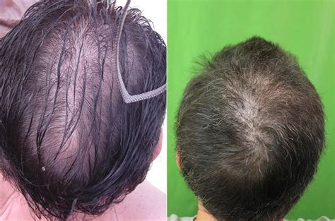 Crown Hair Restoration Dermhair Clinic Los Angeles 1 310 318 1500