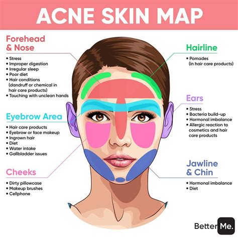 Proskin Aesthetics On Instagram This Is What Acne Says About Your