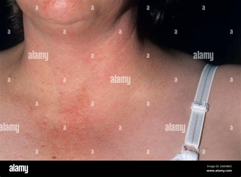 Secondary Cancer Swollen Lymph Gland Lymphadenopathy On The Left