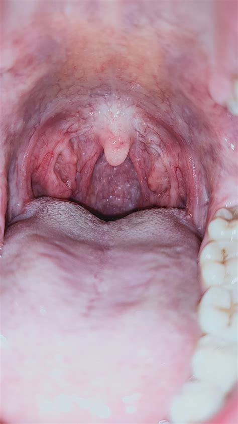 Do My Tonsils Look Normal I Noticed A Little Bump With A White Centre