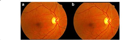 A Fundus Photograph Of A Patient With Mild Npdr A A Small