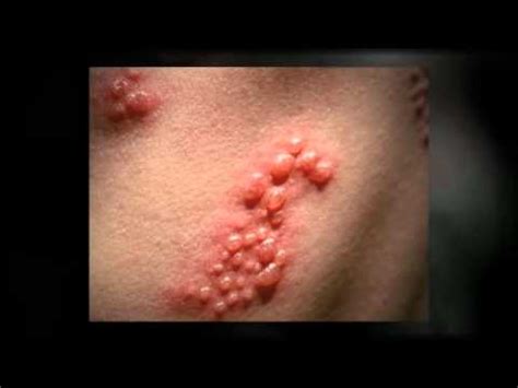 Asphalt shingles are the most common type of roofing material in the united states. What Are The Symptoms Of Shingles Rash? - YouTube