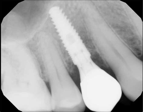 Immediate Premolar Dental Implant
