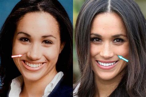 Meghan markle never has a bad hair day. Meghan Markle Plastic Surgery - Nose Job, Teeth - before and after #plasticsurgery | Meghan ...