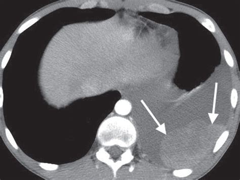 Loculated Pleural Effusion Ct Scan Massive Loculated Pleural Effusion