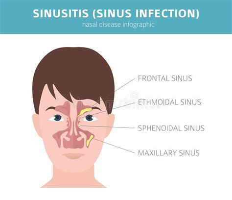Rinitis Viral De La Sinusitis Causada Por El Adenovirus Ilustración Del