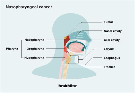 Nasopharyngeal Cancer Causes Diagnosis Treatment And More
