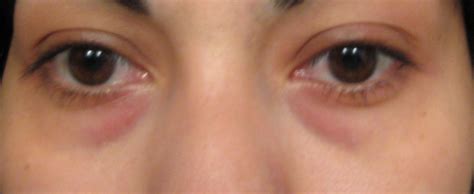 Puffy Eyes With Dark Circles Picture Included What Should I Be