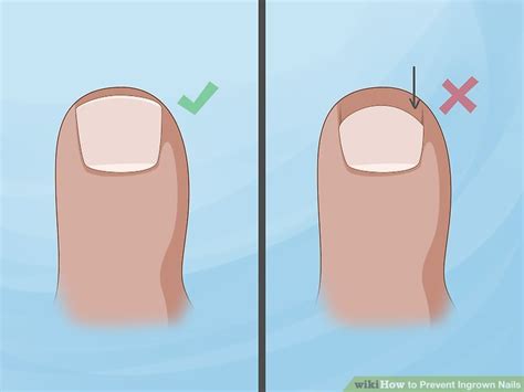 3 Ways To Prevent Ingrown Nails Wikihow