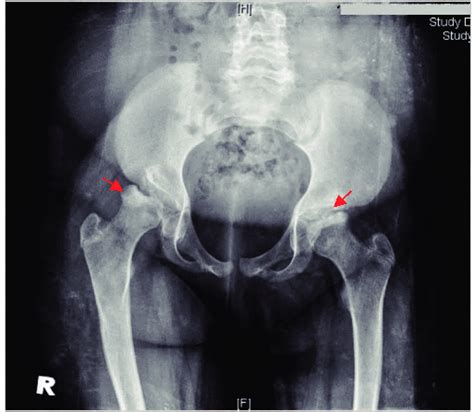 X Ray Of Patient 10 Avascular Necrosis Of Femoral Heads Arrow