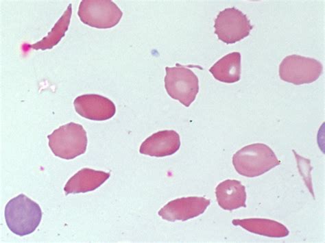 Hemolytic Anemia Evaluation And Differential Diagnosis Aafp
