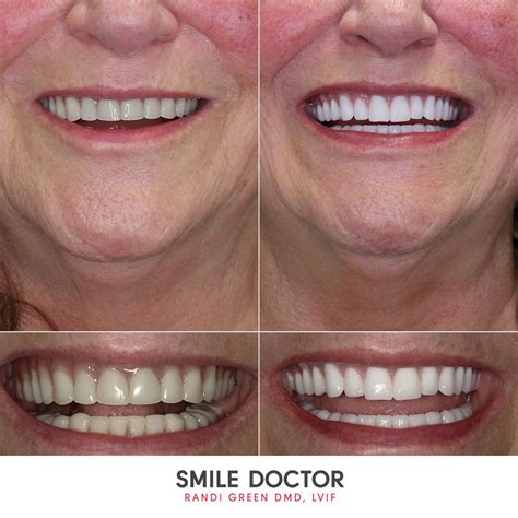 Cosmetic Dentures Smile Doctor Randi Green DMD LVIF