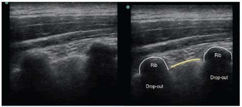 Ultrasound Guided Paravertebral Block Wfsa Resources