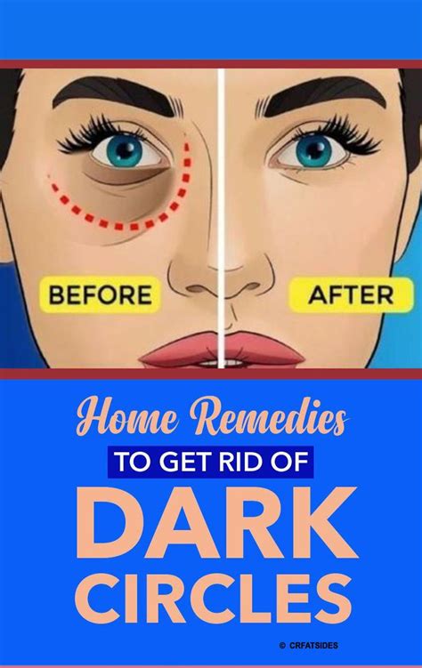 9 Home Remedies For Dark Circles Under Eyes Fast Dark Circles Under