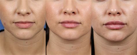 Restylane Juvederm Bigger Poutier Upper And Lower Lips