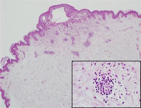 Pemphigoid Gestationis Successfully Treated With Intravenous