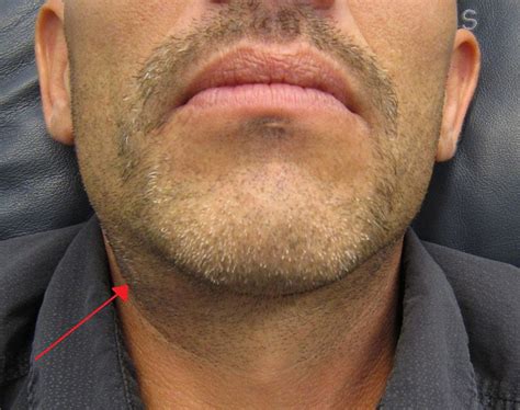Swollen Salivary Glands Under Chin