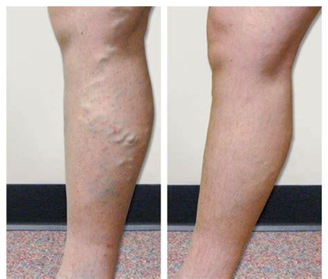 Non Surgical Vein Treatments Vein Specialists Of The Carolinas