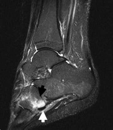 Sagittal Proton Density Fat Saturated MR Image Of The Mid Foot Showing Download Scientific