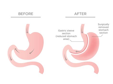 Tijuana Bc Gastric Sleeve Side Effects Sleeve