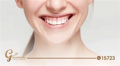 كيفية علاج الابتسامة اللثوية 4 خيارات فعالة اختر من بينها الموقع الرسمي لعيادات Guarantee Dental