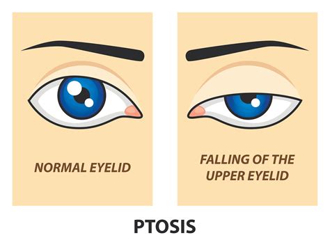 Ptosis Ophthalmology Visual Sciences