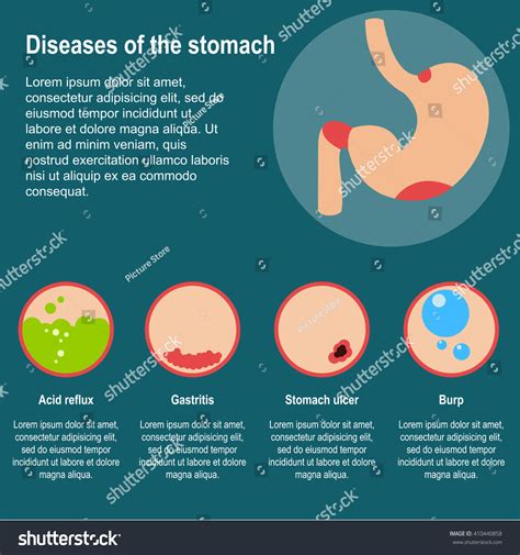 Diseases Stomach Vector Illustration Damage Stomach เวกเตอร์สต็อก