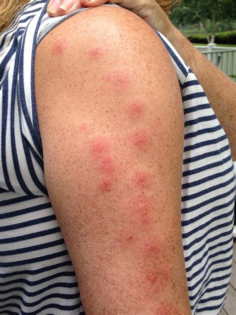 Identify Bug Bites On Humans