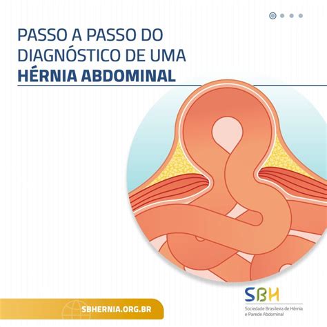 Passo A Passo Para O Diagnóstico De Uma Hérnia Abdominal Sbh