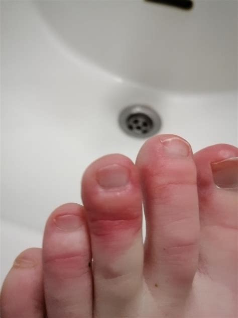Help My Toes Are Burning Itchy Swollen Bubbly More In Comments