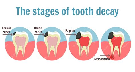 Premium Vector The Stages Of Tooth Decay Infographic Illustration Of