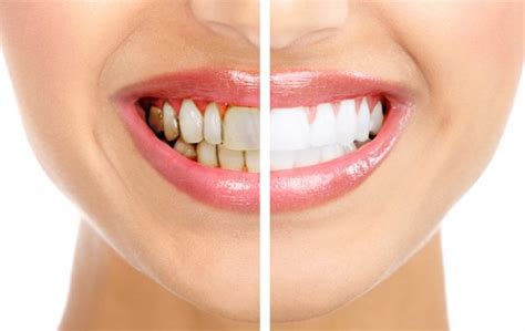 Top 8 Causes Of White Gums Around Teeth