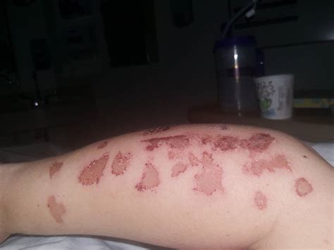 She Thought It Was Just A Rash But Weeks Later Doctors Gave Her