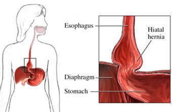 What organ is located is middle of chest under end of rib cage? Hiatal Hernia - www.headbacktohealth.com