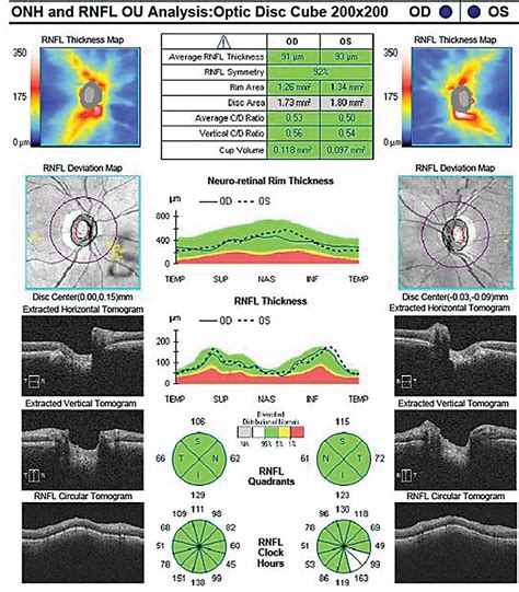 Can You Differentiate These Tough Glaucoma Cases