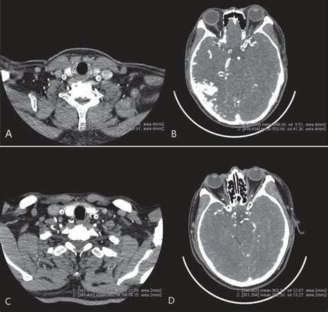 Computed tomography angiography (also called ct angiography or cta) is a computed tomography technique used to visualize arterial and venous vessels throughout the body. Assessment of radiation dose and iodine load reduction in ...