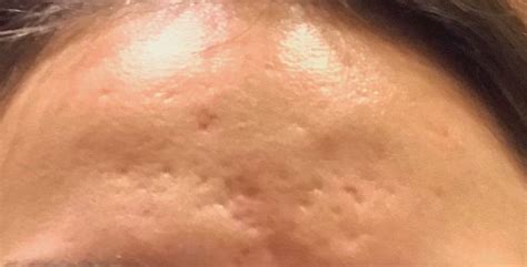 Acne Skin Concerns Forehead Acne Scars Completely Lost As To