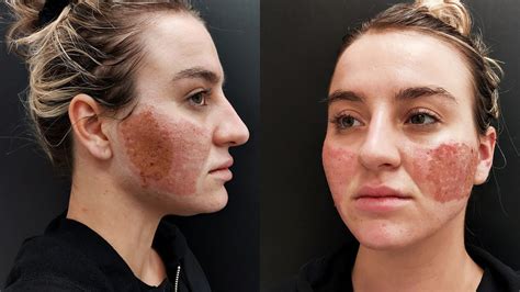Acne Scar Removal With Co2 Laser Treatment Before And After Redsail Laser