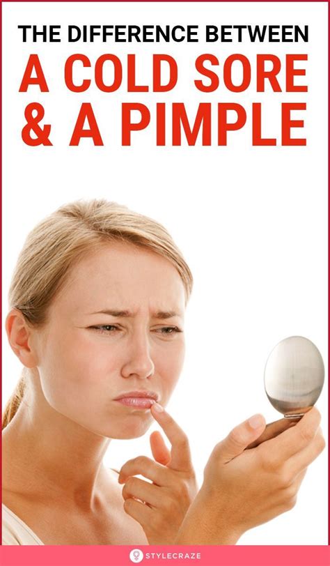 Cold Sores Vs Pimples What Do You Have And Treatment Options In 2021