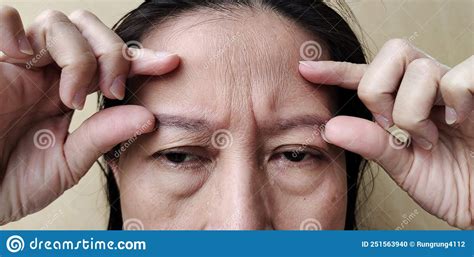 The Flabby Sagging And Forehead Lines On The Face Stock Photo Image